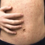 Sarampión en La Palma